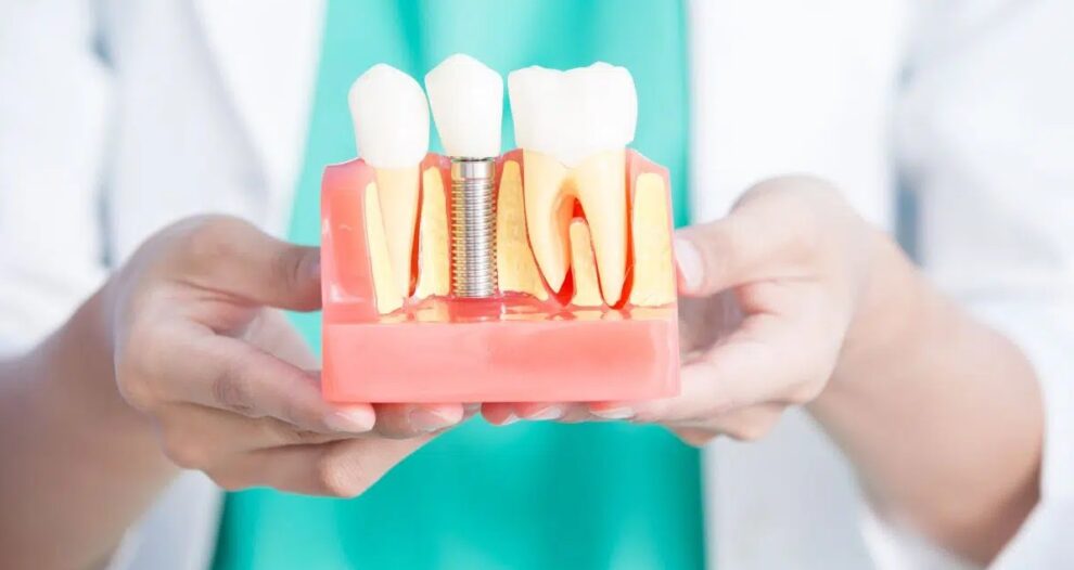 Importanta implanturilor dentare pentru recuperarea danturii pierdute